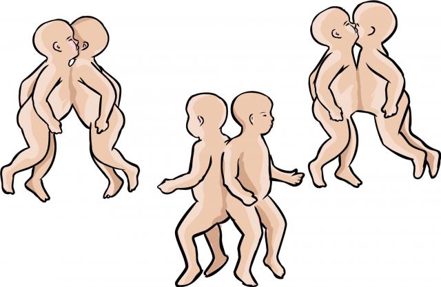 Sijamski blizanci sa spojenim glavama uspešno razdvojeni